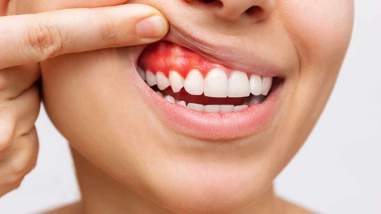 Diş Eti İltihabı Nedir? Nasıl Geçer?