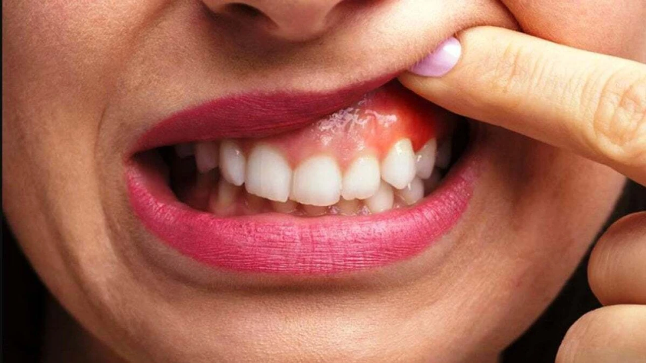 Diş Eti Şişmesi Nedir? Belirtileri, Nedenleri ve Tedavi Yöntemleri