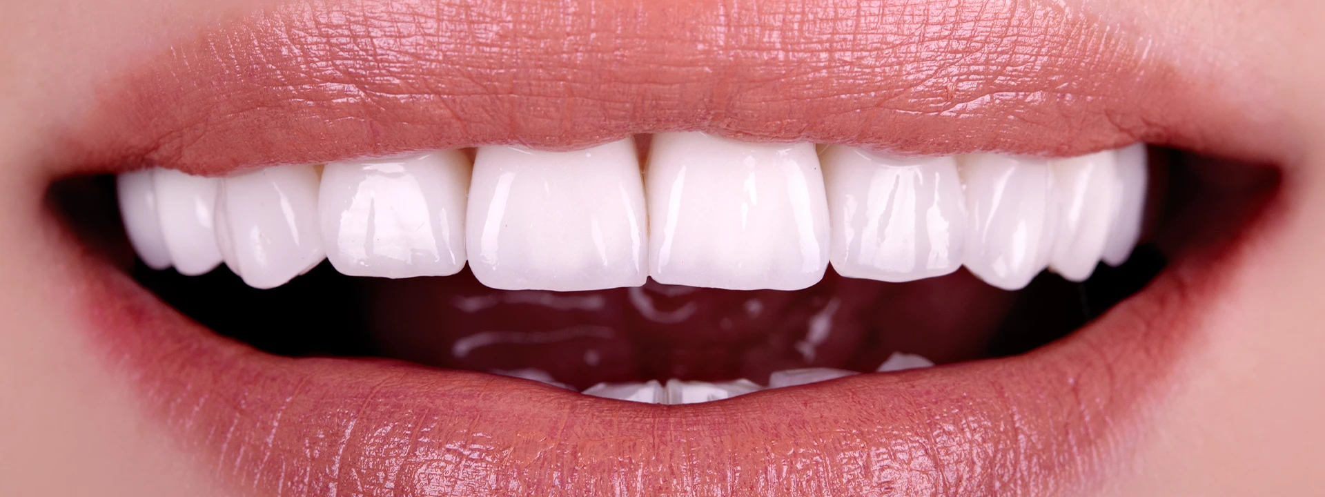 Cosmetic Dental Veneers in Antalya Cosmetic Dental Veneers in Antalya