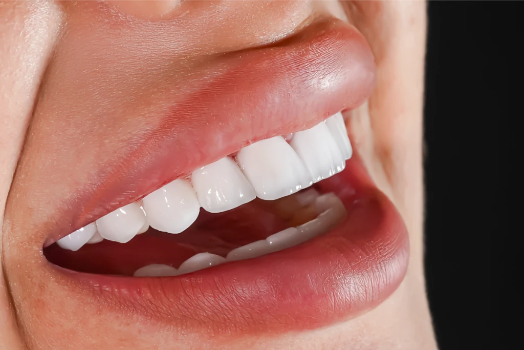 Dental Bridge Dental Bridge