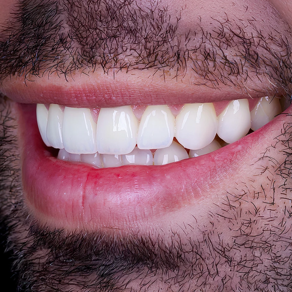 Dental Implants Dental Implants