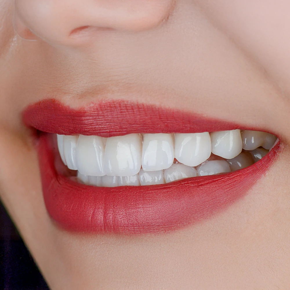 Dental Veneers Dental Veneers