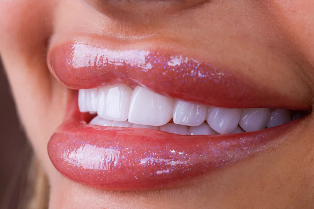 E-Max Crowns