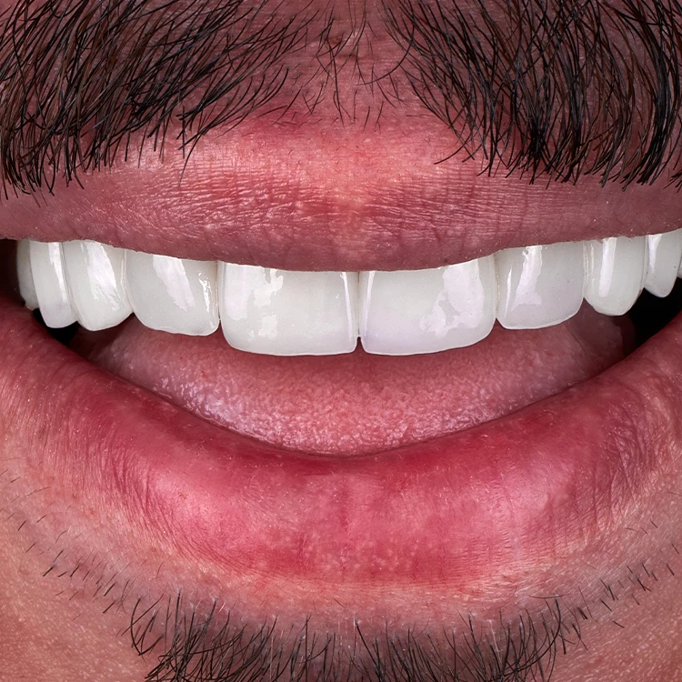 How to Maintain Your Veneers How to Maintain Your Veneers