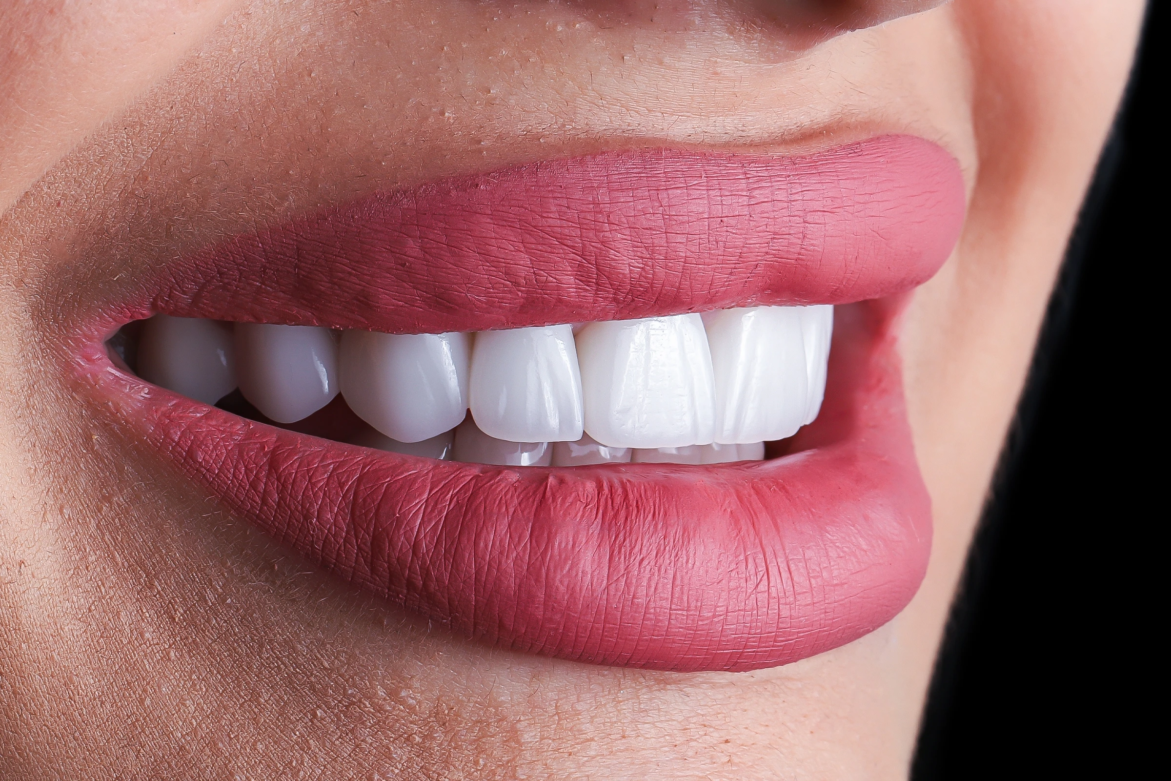 Metal Porcelain Crowns Metal Porcelain Crowns