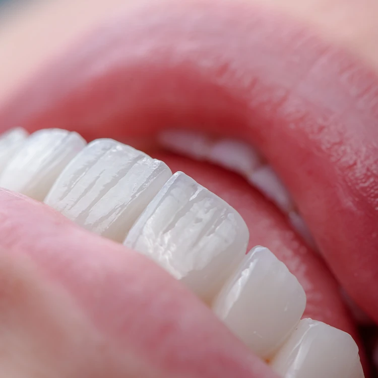 Types of Veneers We Offer Types of Veneers We Offer