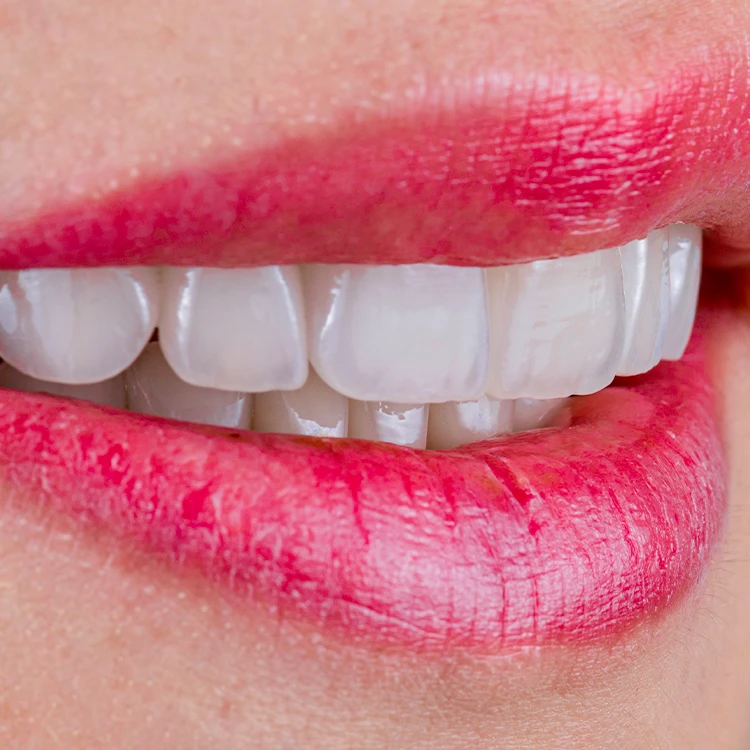What Are Cosmetic Dental Veneers? What Are Cosmetic Dental Veneers?