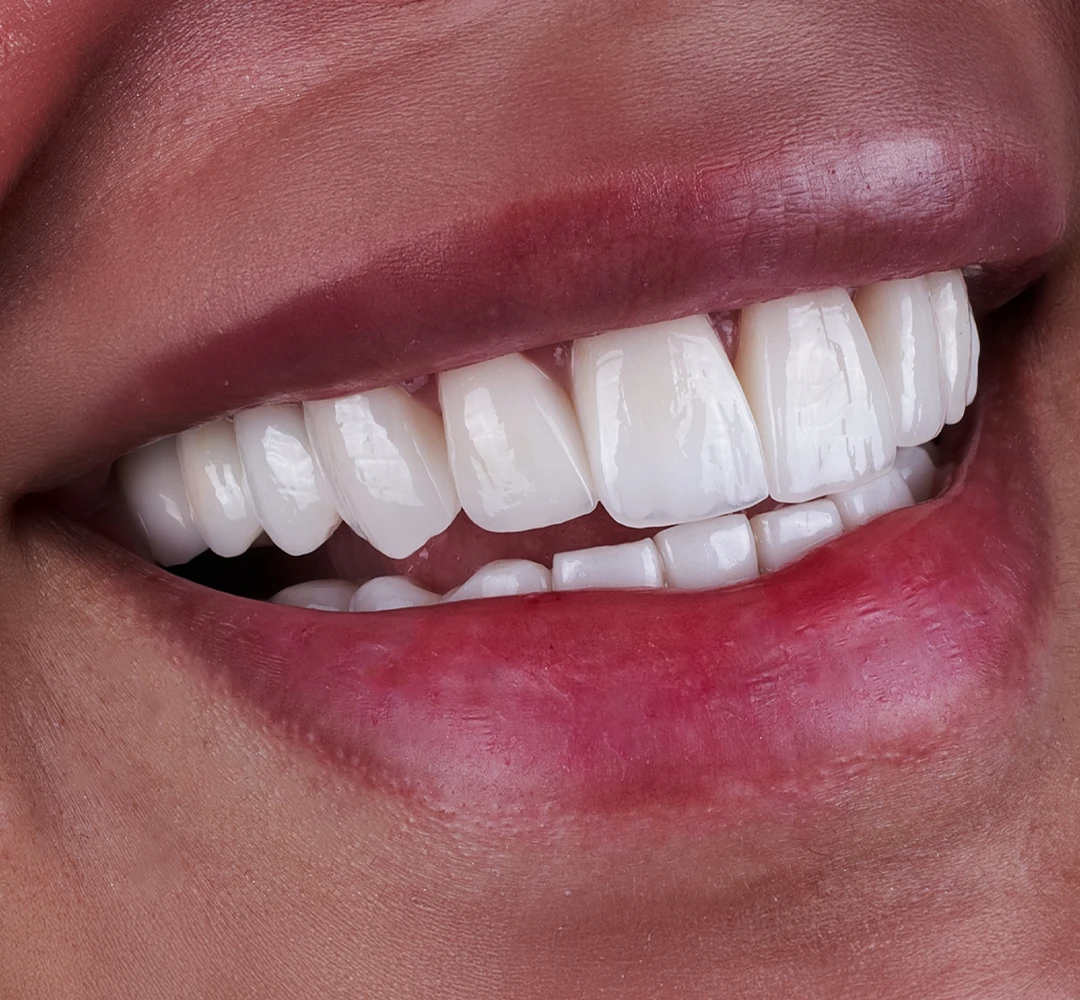 Zirconium Crowns (Zirconia Crowns) Zirconium Crowns (Zirconia Crowns)