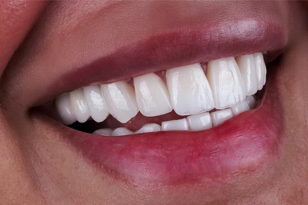 Zirconium Crowns (Zirconia Crowns) Zirconium Crowns (Zirconia Crowns)